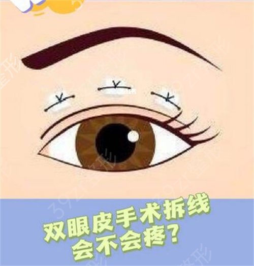 韩式三点双眼皮能拆吗？