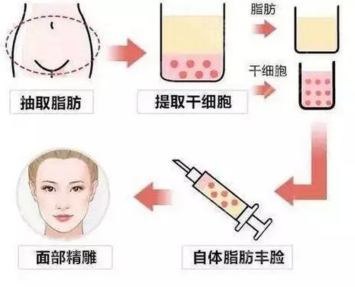 南京医科大学友谊整形外科医院提前出炉，附脂肪填充案例