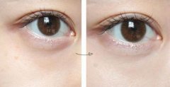 激光去黑眼圈副作用有哪些？