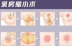 乳房缩小术前注意有哪些?