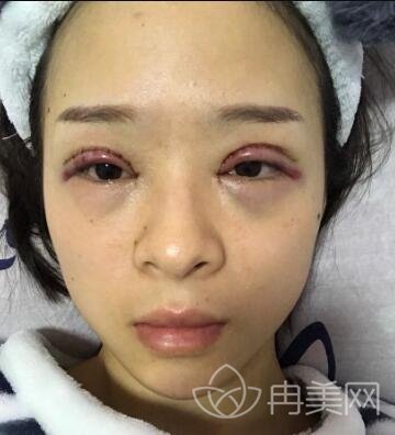 亚韩割双眼皮多少钱双眼皮真人案例恢复过程自述及前后对比照