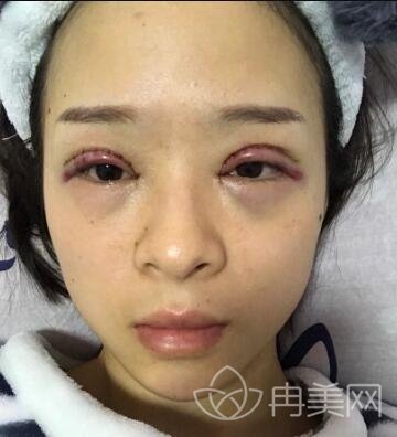 双眼皮真人案例恢复过程自述,及前后对比照