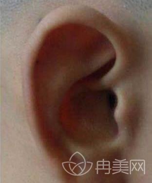 【日记】庄洪兴全耳再造术后耳朵完整，跟真的一样解救自卑者