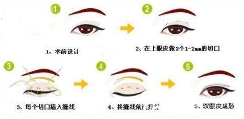 韩式三点定位双眼皮价格通常多少钱？