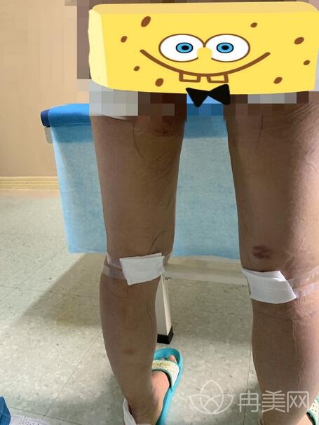 盐城东方女子医院吸脂案例及价格表2019一览