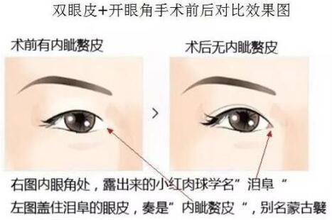 双眼皮手术后热敷会加重疤痕增生吗?
