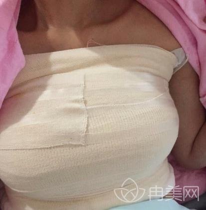 驻马店159医院美容整形科价格表及自体脂肪隆胸恢复效果分享