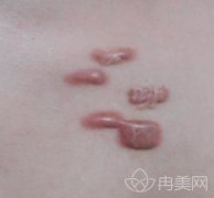 荆州市第三人民医院美容科去疤痕怎么样？案例果图欣赏