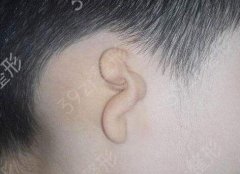小耳畸形的矫正一般持续多长时间?