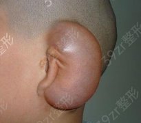 小耳畸形的矫正手术方法有哪些?