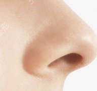 鼻翼缩小术留疤几率大吗?鼻孔整形内切和外切信息介绍?
