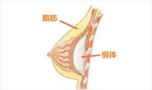 天津医科大学第三医院整形外科假体隆胸案例：