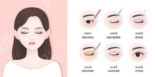 韩式定点双眼皮怎么样？能维持多久？