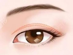 眼部抽脂手术后眼睛可以变大吗？