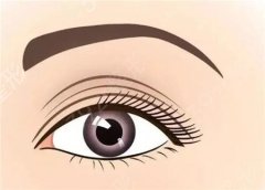 如何判断自己适合哪种双眼皮手术？