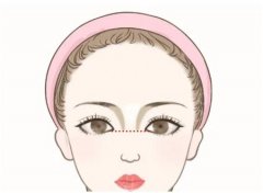 驼峰鼻矫正有哪些优点和缺点
