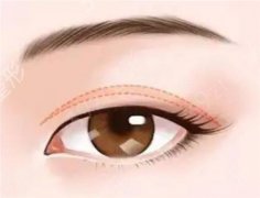 肿眼泡适合什么样的双眼皮手术