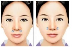 如何降低驼峰鼻矫正的风险