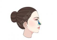 如何矫正大蒜鼻，有哪些手术方法