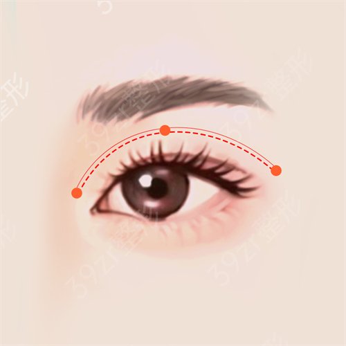 韩式三点双眼皮是埋线还是割？