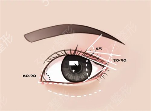 双眼皮形状有哪几种?如何选择适合自己的眼型？