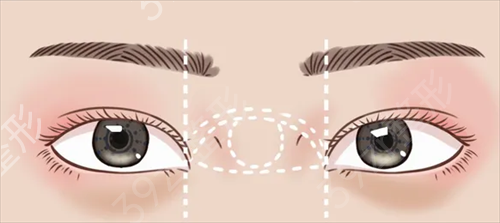 眼球突出能割双眼皮吗?