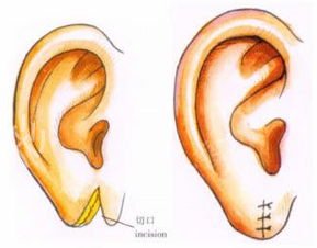 小耳畸形是怎么造成的?