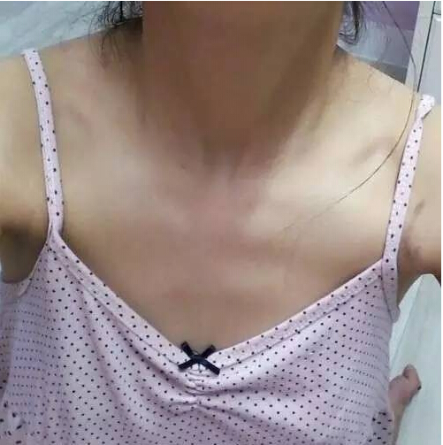 假体隆胸让我从A变到了C,终于挺了大了