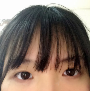 成都大眼睛整形医院沈燕华医生微创双眼皮技术,这样的果你们怎么看?