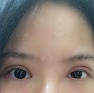 成都大眼睛整形医院沈燕华医生微创双眼皮技术,这样的果你们怎么看?