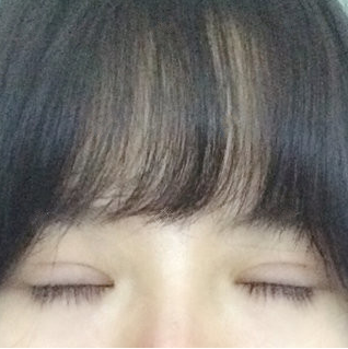 成都大眼睛整形医院沈燕华医生微创双眼皮技术,这样的果你们怎么看?