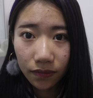 合肥红妆鼻部手术整形介绍分享