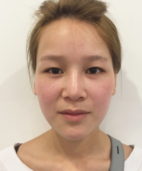 上海伯思立鼻部手术+双眼皮恢复过程介绍