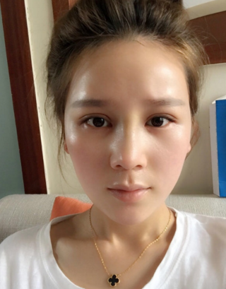 上海伯思立鼻部手术+双眼皮恢复过程介绍