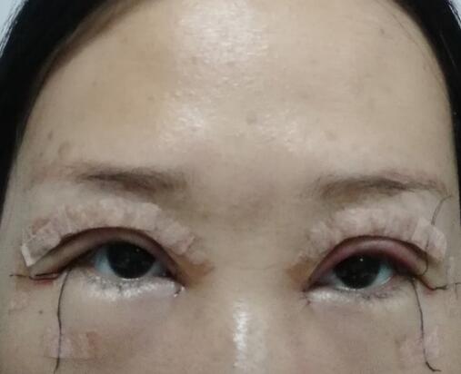记录我的全切双眼皮10天恢复全过程，眼部详情图分解~
