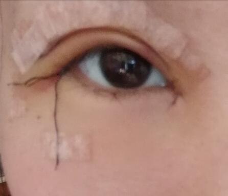 记录我的全切双眼皮10天恢复全过程，眼部详情图分解~