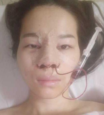 隆鼻十天后的恢复情况,丑小鸭女孩的蝶变之旅