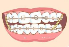 t4a牙齿矫正器佩戴方法演示图