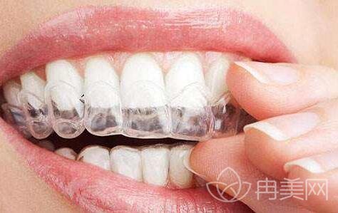 牙齿矫正一般多久才能恢复?