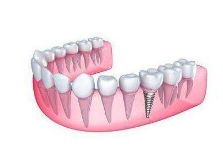 种植牙的利与弊，种植牙手术调节过程