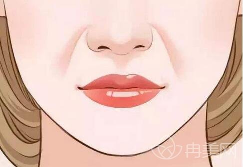鼻唇沟提升是怎么回事? 是怎么做的?