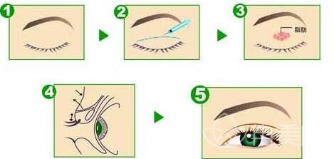双眼皮手术失败如何修复?修复方法介绍