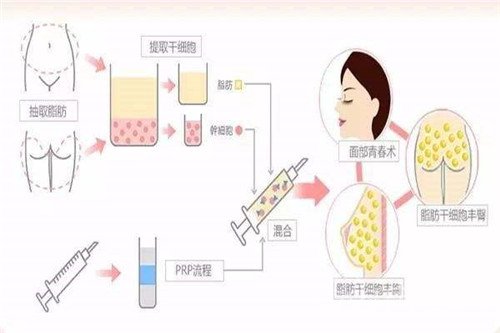 韩国自体细胞注射除皱可以保持多久呢?
