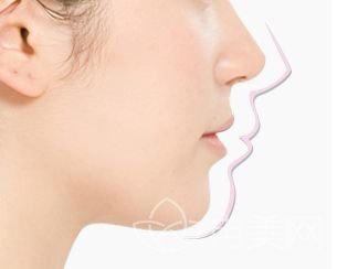 整容垫鼻子有什么后遗症？
