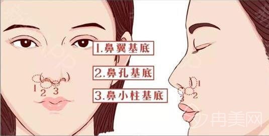 垫高鼻子的副作用有哪些?