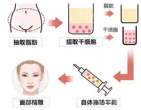在北京做了自体脂肪填充脸肿了怎么办?