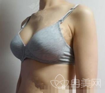 西安西京乳房下垂矫正恢复日记分享，6个月就可变成大胸