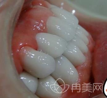无锡江阴市摩尔口腔医院价格表明细公布，附牙齿矫正案例
