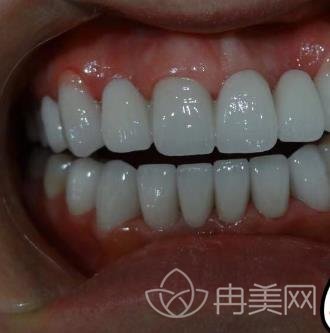 无锡江阴市摩尔口腔医院价格表明细公布，附牙齿矫正案例