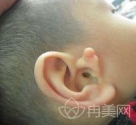 内蒙古一机医院整形科一览，耳畸形修复过程分享